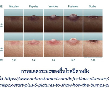  แพทย์รามาธิบดี แนะวิธีป้องกันโรคฝีดาษลิง ควรตระหนักแต่ไม่ตื่นตระหนก  พร้อมตั้งรับความช่วยเหลือสำหรับผู้ป่วยยากไร้ และการวิจัยโรคอุบัติใหม่